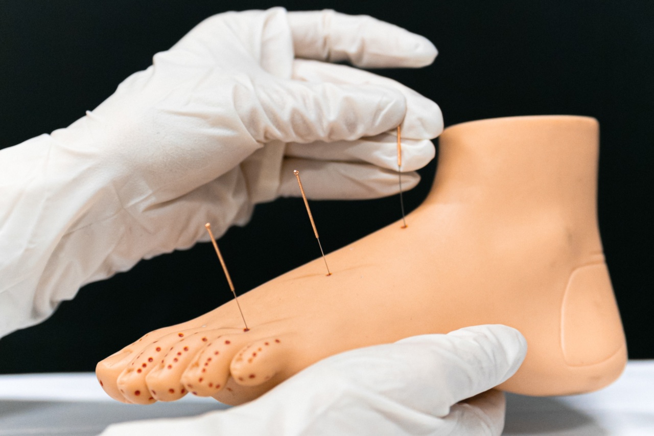 Eliminate Acupuncture with Acupuncture Techniques