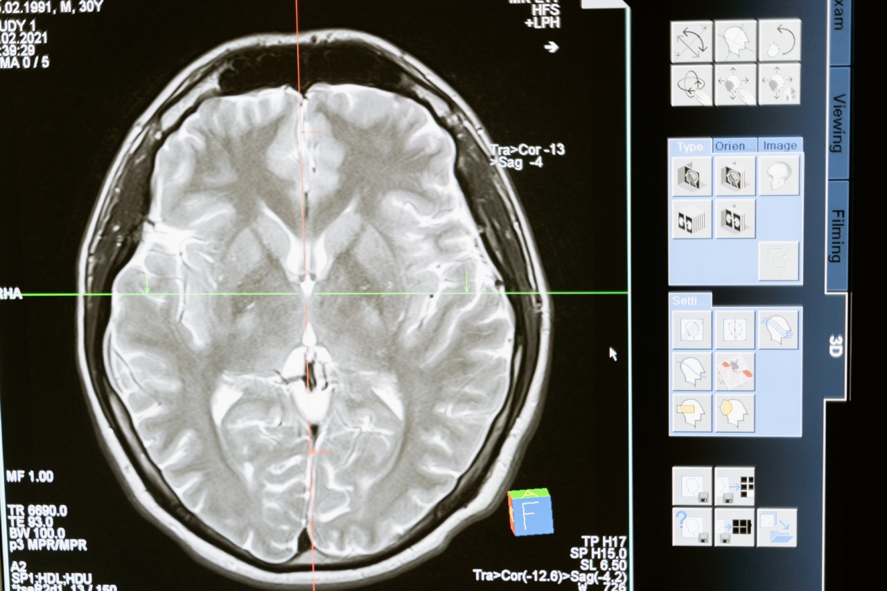 Understanding the Science of Depression in the Brain