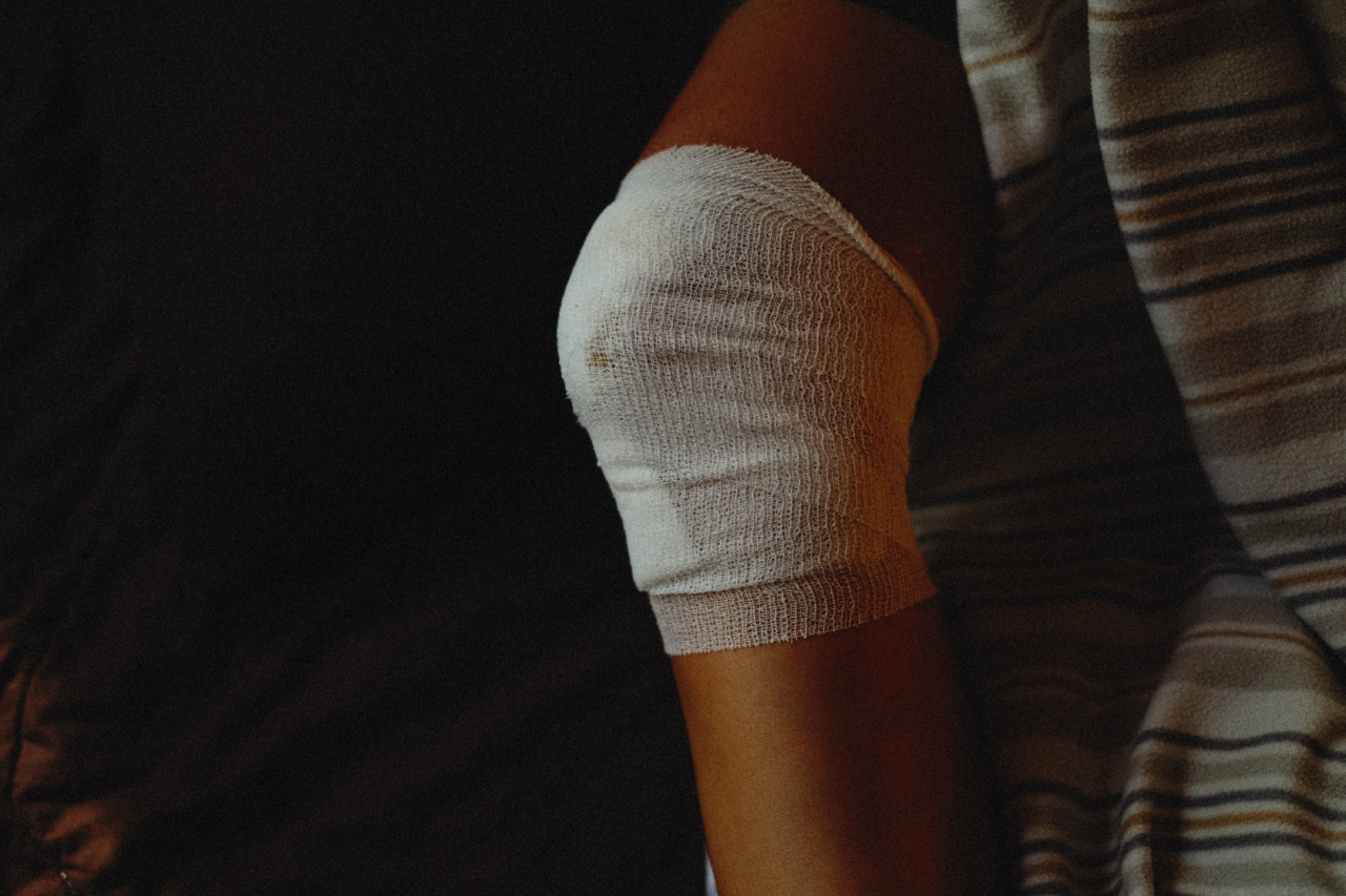 The reason behind your easily bruised skin