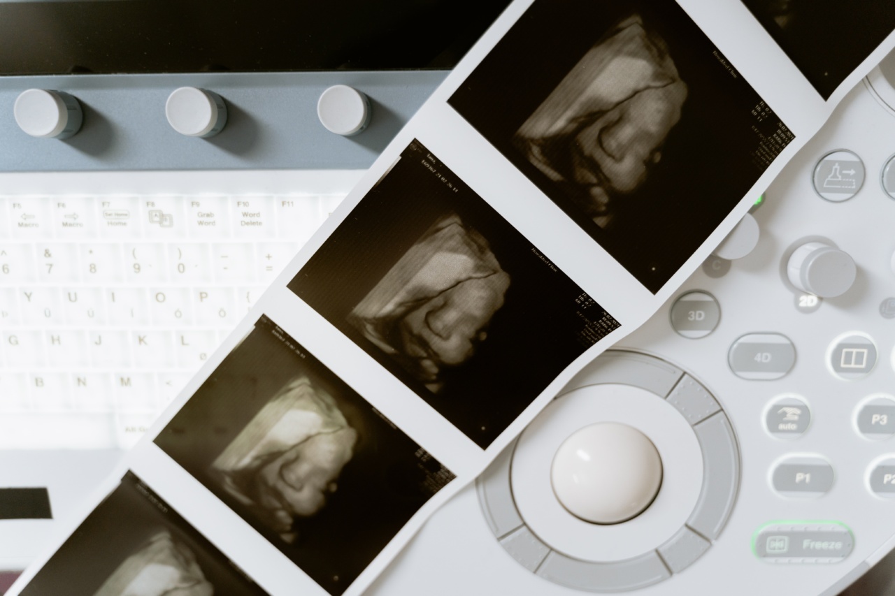 Varicose veins and the importance of ultrasound imaging