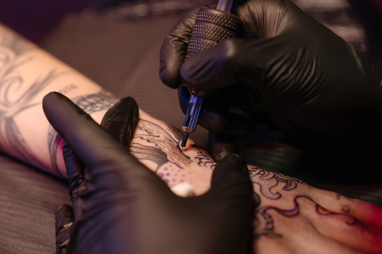 The Process of Tattoo Removal