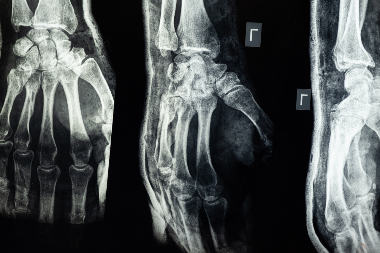 Injuries: 5 ‘armor bones’