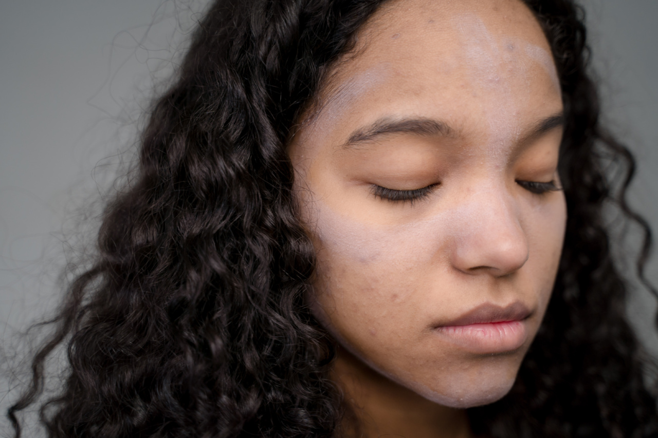 Adult Acne: What’s Happening to Your Skin and Why
