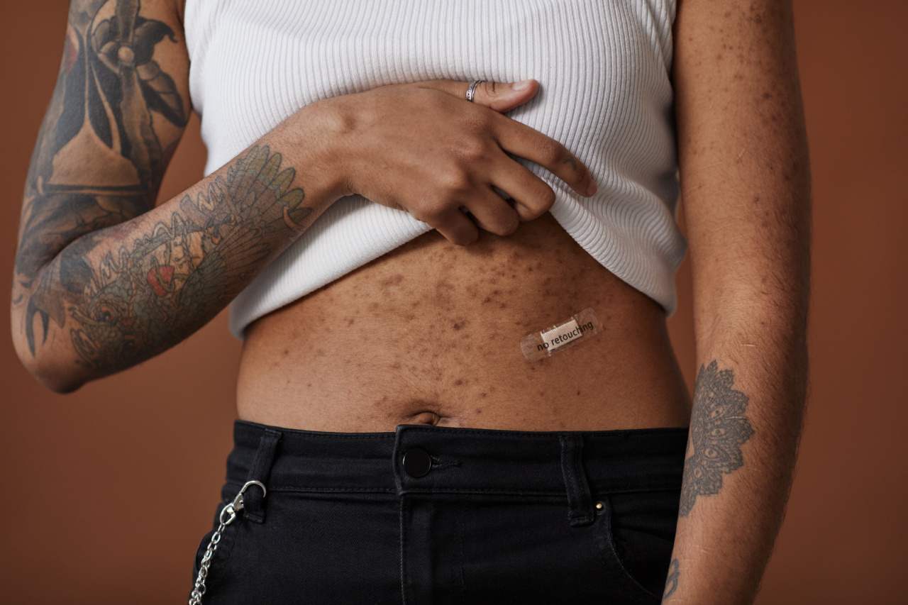 Don’t Let Body Acne Keep You Down