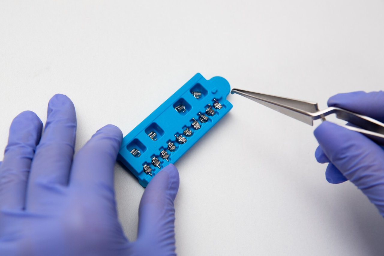What are my options for orthodontic treatment without metal braces?