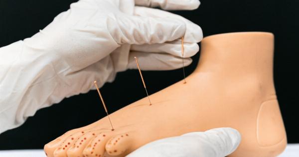 Eliminate Acupuncture with Acupuncture Techniques