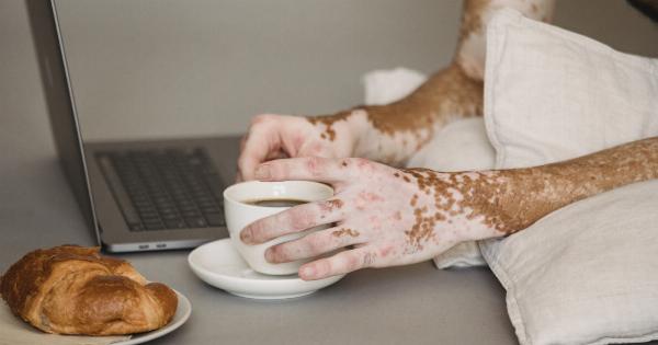 Beyond Skin: Understanding Psoriasis