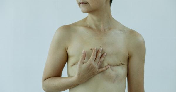 How Breast Reconstruction Extends Survival after Mastectomy