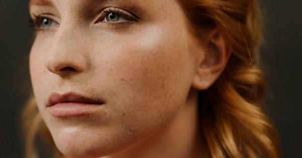 What Do Facial Freckles Indicate About Your Health?