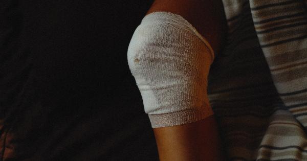 The reason behind your easily bruised skin