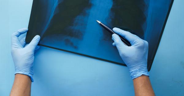 Foods for Faster Fracture Healing: A Picture Guide to Essential Nutrients