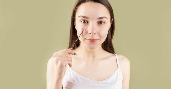 The Top Acne Treatment Mistakes and How to Avoid Them