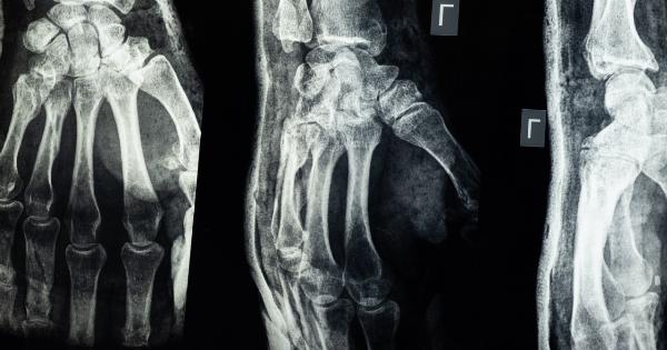 Injuries: 5 ‘armor bones’